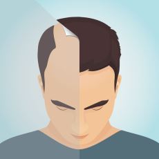 Operasyon Geçirmiş Birinin Kaleminden: Saç Ektirmeye Dair Bilmeniz Gereken Her Şey