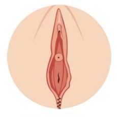 Estetik ve İşlevsel Amaçla Yapılan Operasyon: Vajina Daraltma Ameliyatı (Vajinoplasti)
