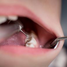 Dişler, Her Gün Fırçalanmasına Rağmen Neden Çürüyebiliyor?