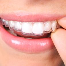 Diş Teline Gerek Kalmadan Dişteki Çapraşıklığı Düzelten Plak Tedavisi: Invisalign