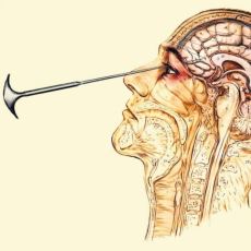 Psikiyatrik Hastaların Beyinlerinin Bir Bölümünün Kesilerek Tedavi Olmasını Sağlayan Yöntem: Lobotomi