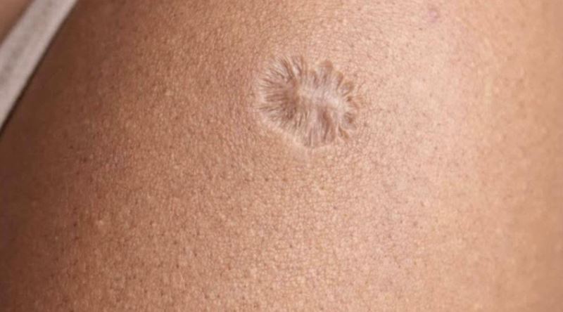 Çocukken Yapılan Aşı Sol Omzumuzda Neden Yuvarlak Bir İz Bıraktı?
