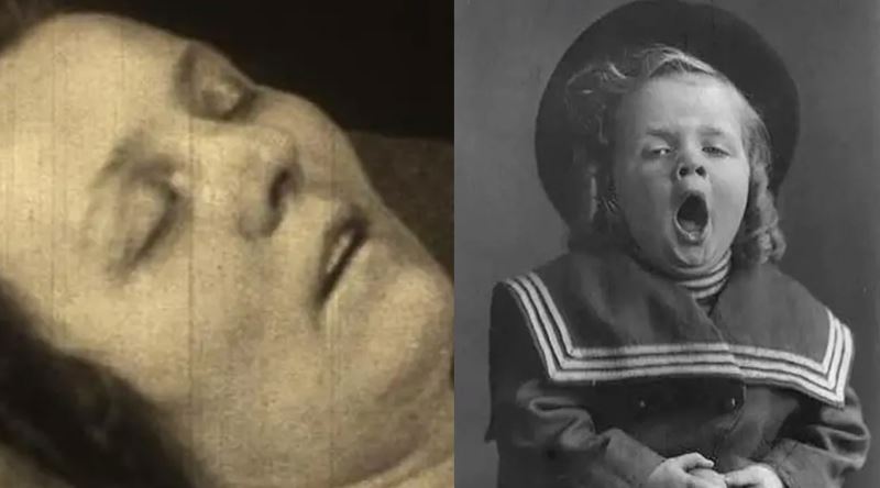 Milyondan Fazla İnsanı Etkileyen Tıbbın Büyük Gizemlerinden Biri: Ensefalit Lethargica