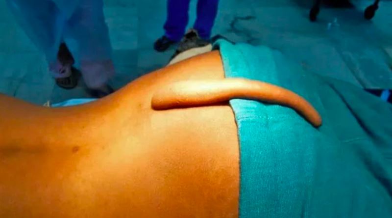 Evrim Geçirmeye Devam Ettiğimizin Kanıtı Olan Bedensel Kalıntılar