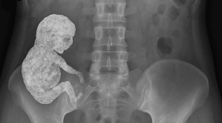 Ölen Fetüsün Anne Karnında Taşlaştığı Çok Nadir Bir Tıbbi Durum: Lithopedion