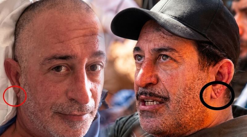 Kulak Memesindeki Frank Çizgisi Kalp Krizine mi İşaret Ediyor?